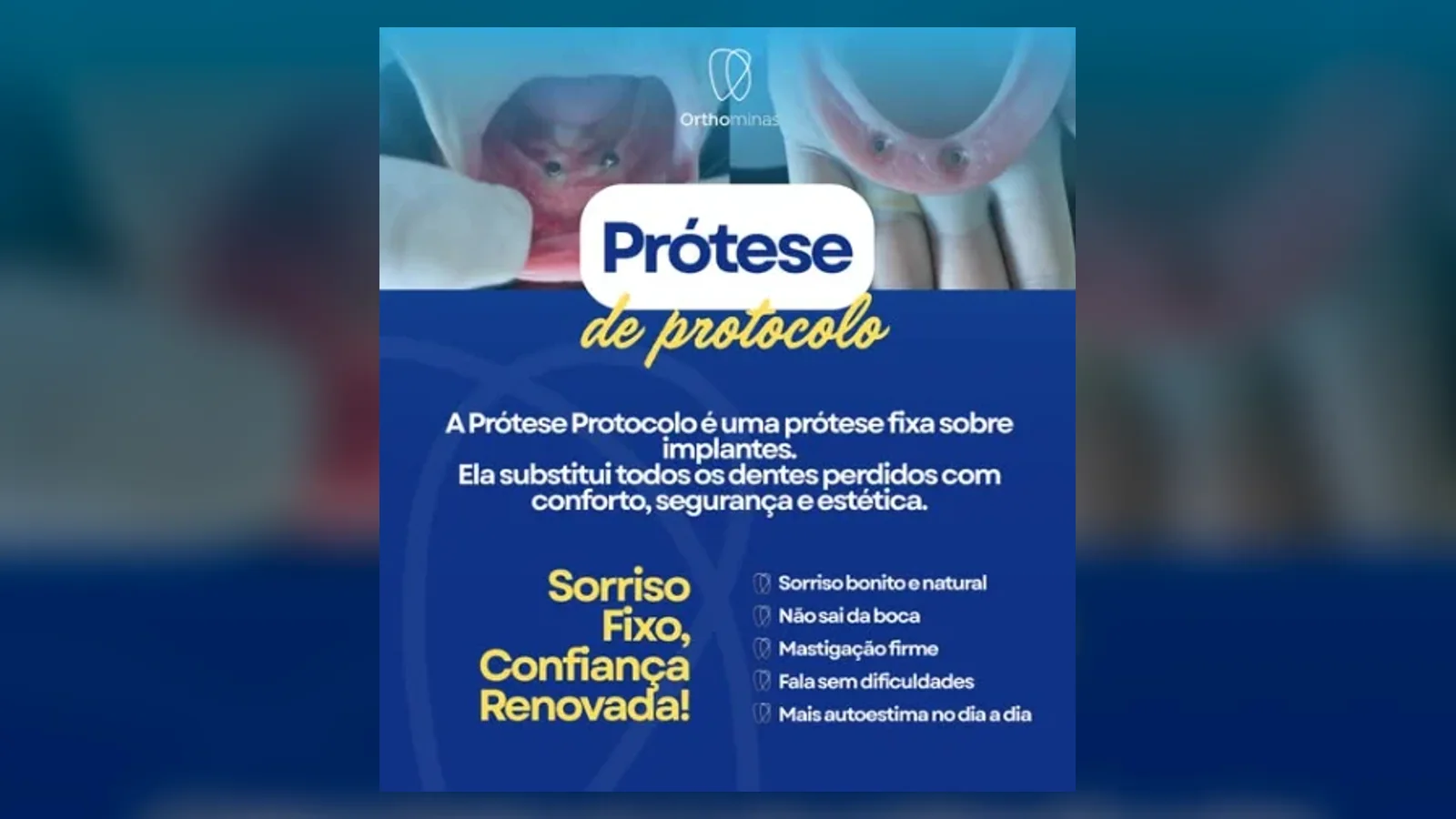 Banner do artigo Prótese protocolo: segurança para voltar a sorrir e mastigar