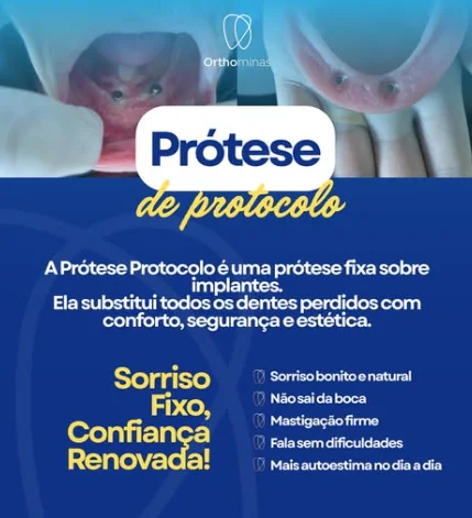 Prótese protocolo sobre implantes na Orthominas em Eunápolis