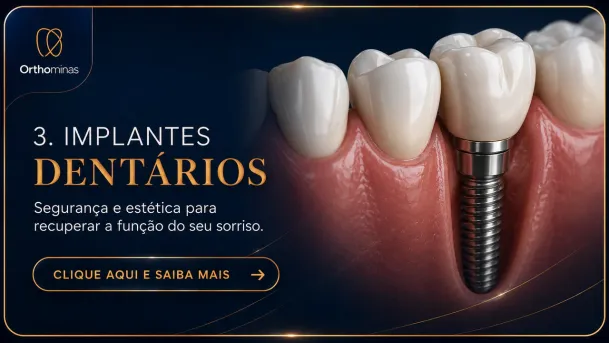 Implantes Dentários